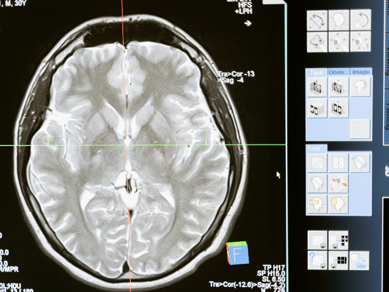 การตรวจเอกซเรย์คอมพิวเตอร์ (CT Brain)