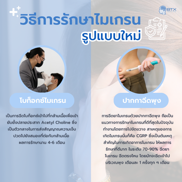 การรักษาไมเกรน