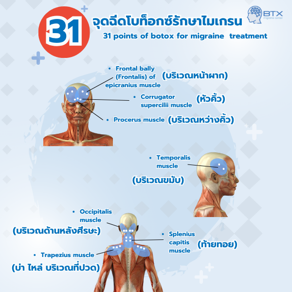 จุดฉีดโบไมเกรน